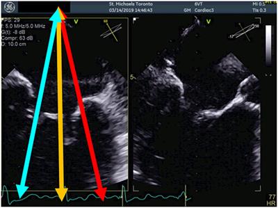 Percutaneous Mitral Edge-to-Edge Repair: State of the Art and a Glimpse to the Future